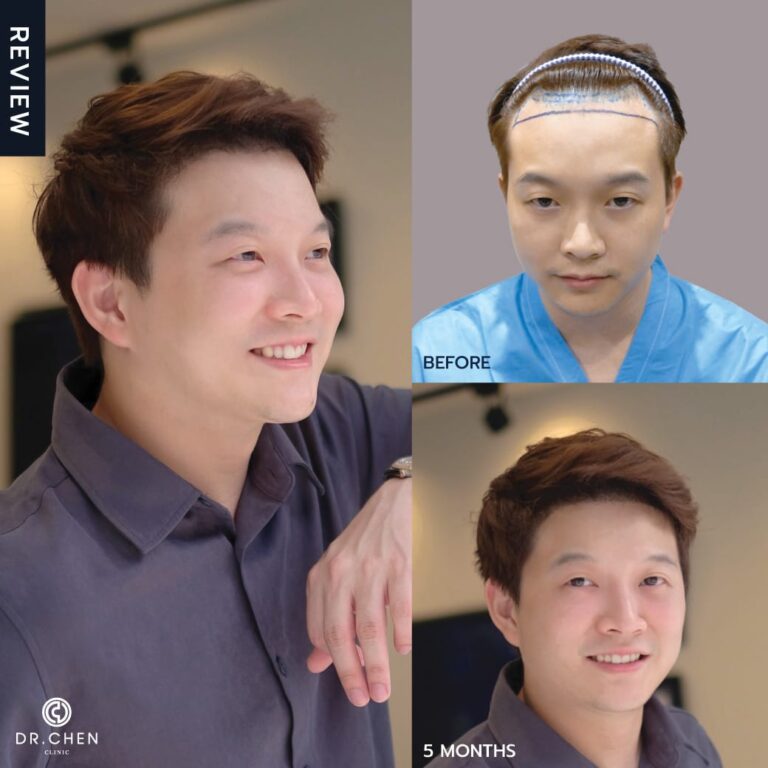 Selected hair transplant result example at DCH Hospital