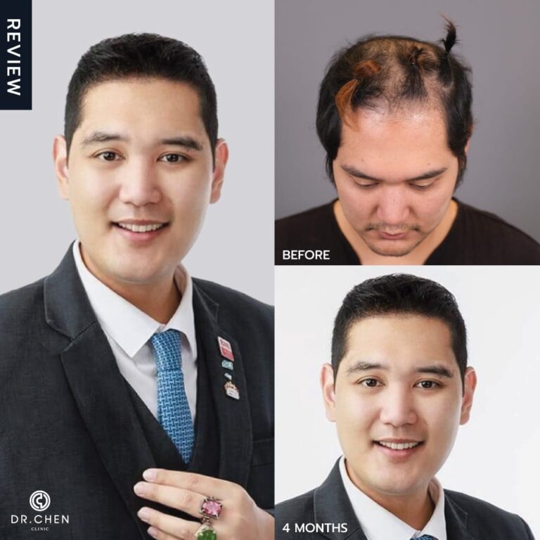 Selected hair transplant result example at DCH Hospital