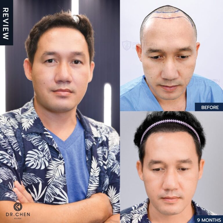 Selected hair transplant result example at DCH Hospital