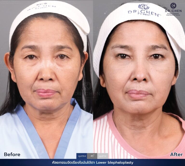 Lower blepharoplasty review 2