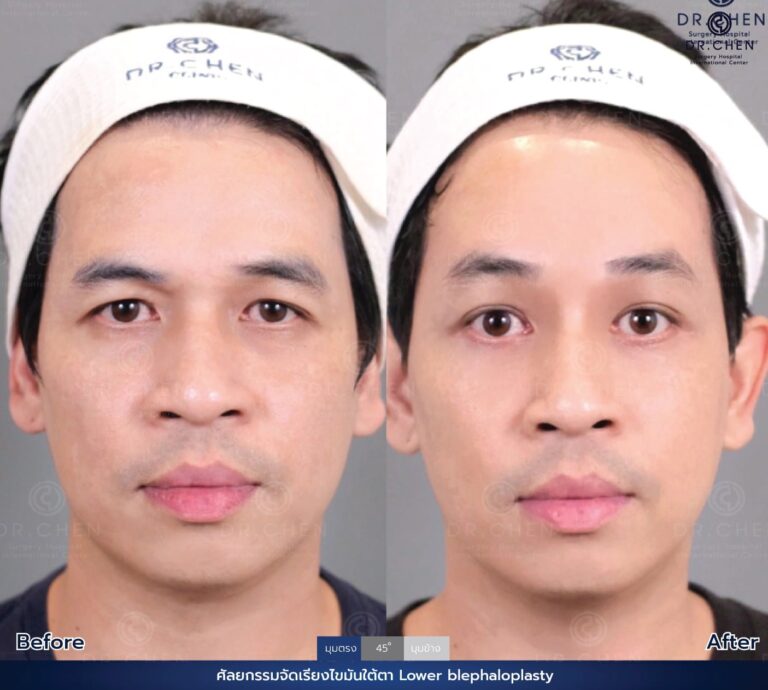 Lower blepharoplasty review 3