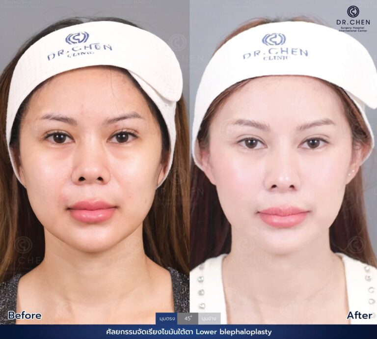 Lower blepharoplasty review 1