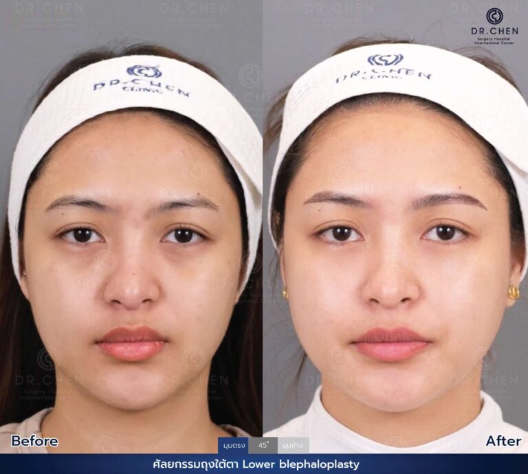 Lower blepharoplasty review 4