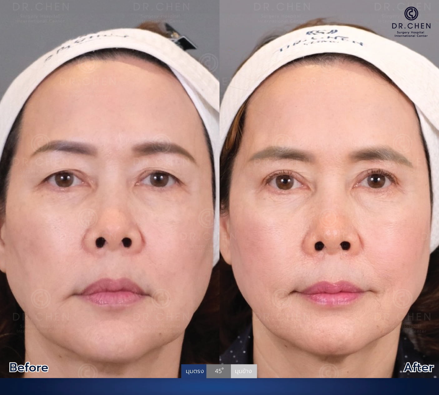 Eye surgery review 4