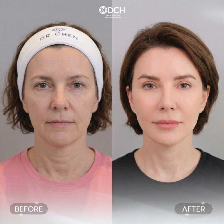 Facelift