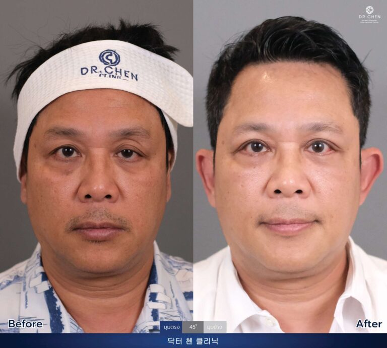 Lower blepharoplasty review 5