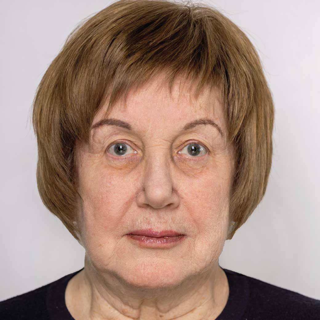 Facelift