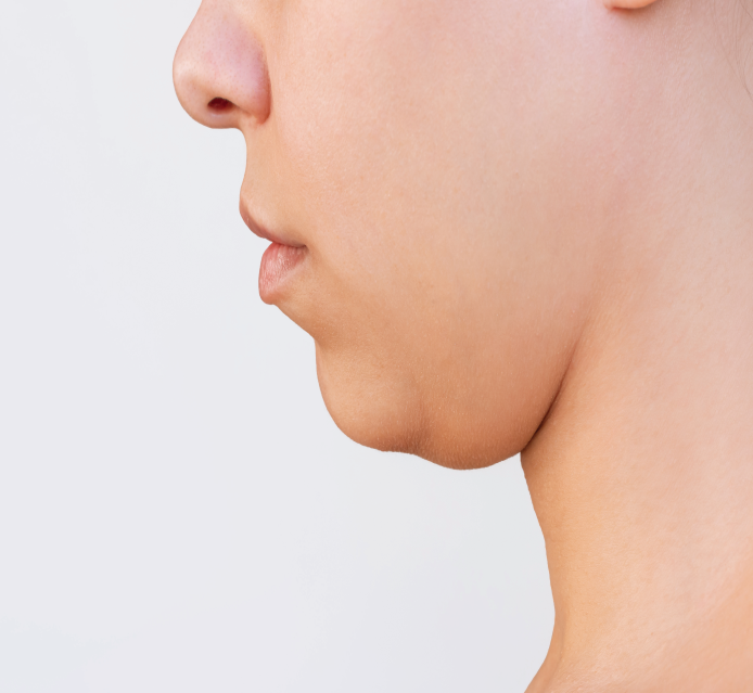 liposuction