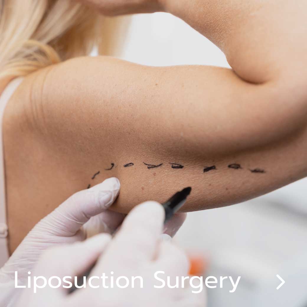 Liposuction surgery