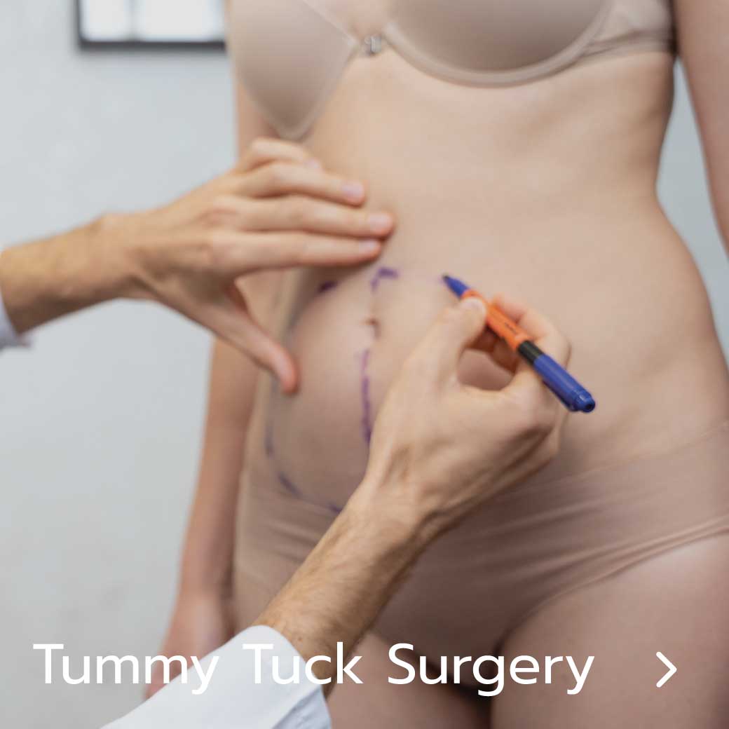 Tummy Tuck