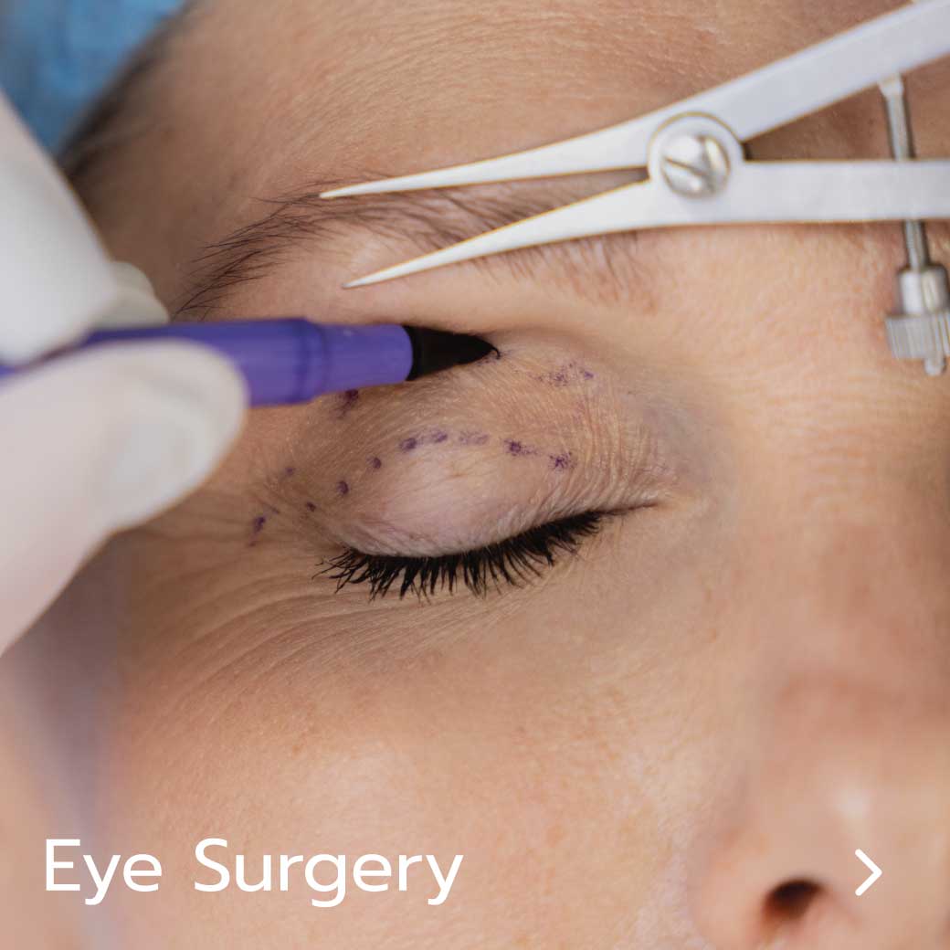 Endoscopic brow lift