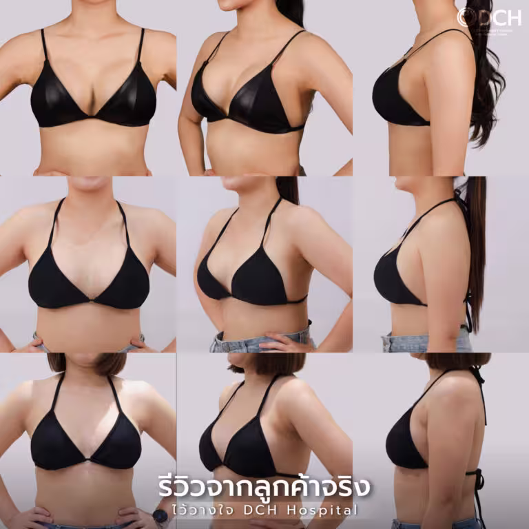 Breast augmentation patient result gallery at DCH Hospital