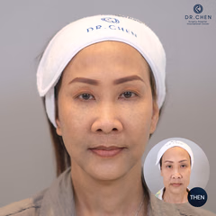 Facelift result 5