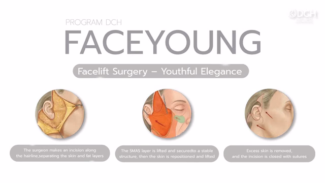 Facelift SMAS