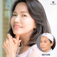 Facelift result 10