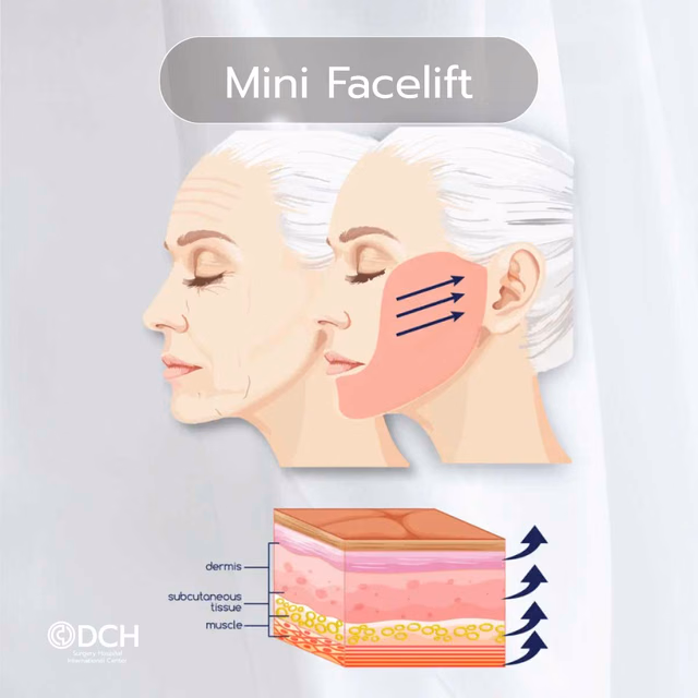 Technique 1 · Mini Facelift