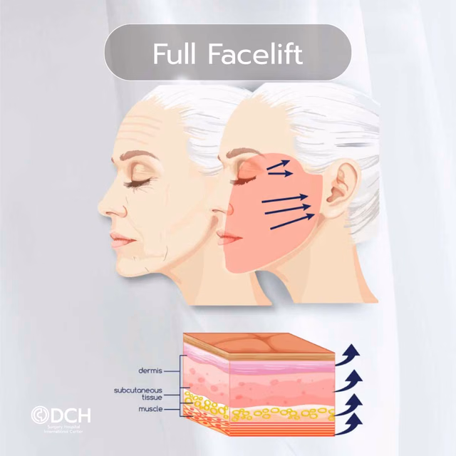 Technique 2 · Full Facelift