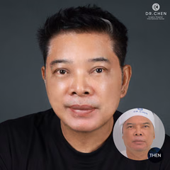 Facelift result 1