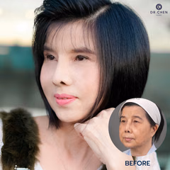 Facelift result 8