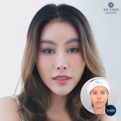 Facelift result 2
