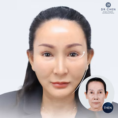 Facelift result 9
