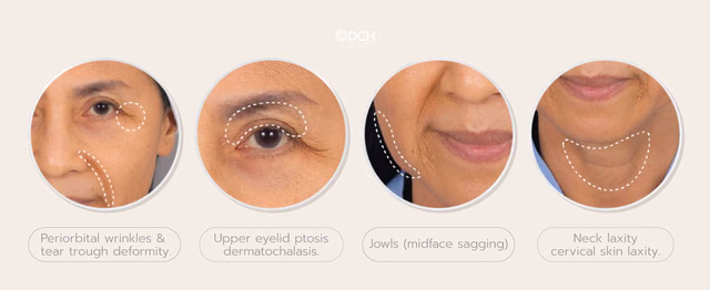What is Facelift Surgery