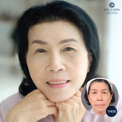 Facelift result 3