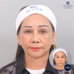 Facelift result 7
