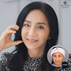 Facelift result 4