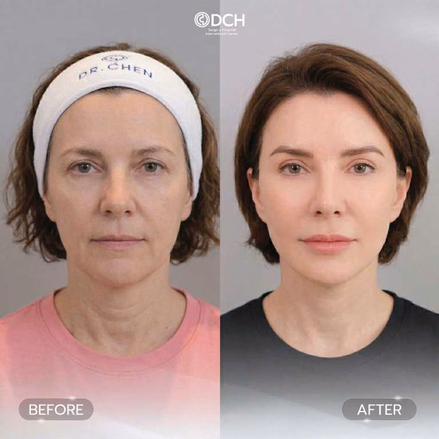 Benefits of DCH FACE YOUNG Facelift