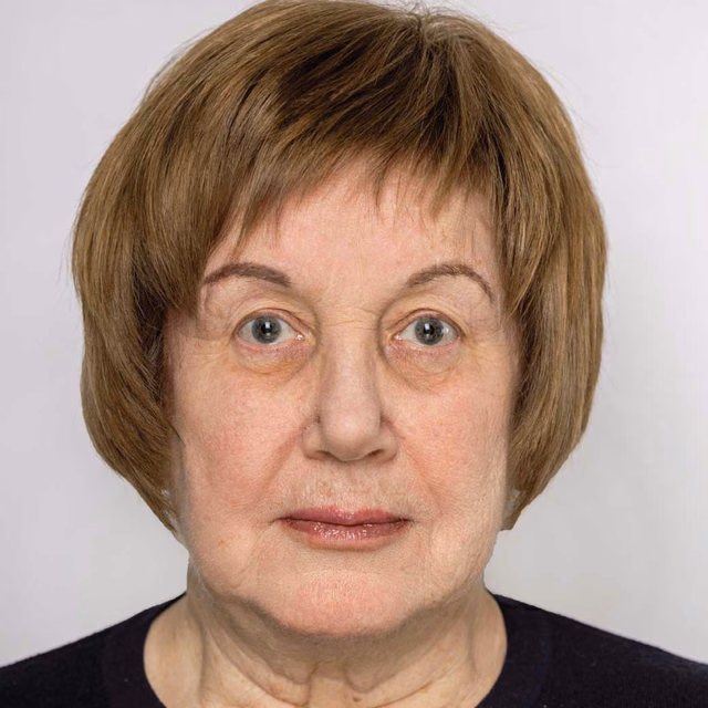 Facelift before