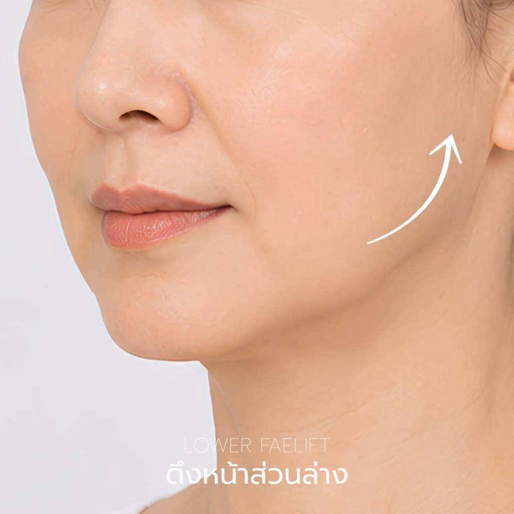 ภาพอธิบายการดึงหน้าส่วนล่างบริเวณกรอบหน้าและแนวกราม