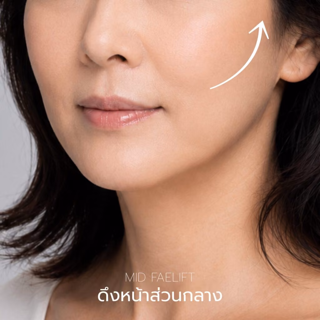 ภาพอธิบายการดึงหน้าส่วนกลางบริเวณแก้มและร่องแก้ม