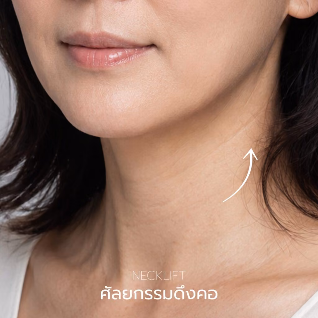 ภาพอธิบายศัลยกรรมดึงคอบริเวณใต้คางและลำคอ