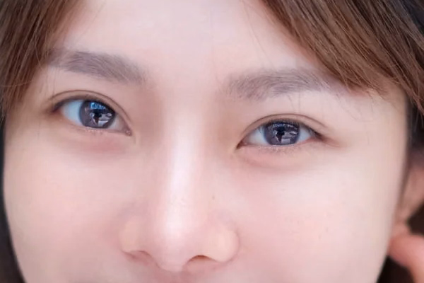 Upper Eyelid Creases In An Original DCH Hospital Photograph