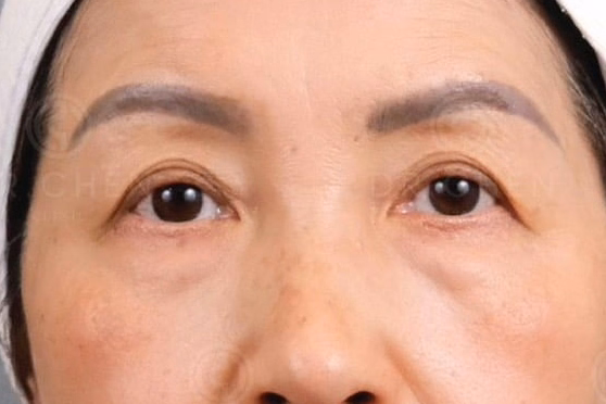 Upper Eyelid Skin In An Original DCH Hospital Photograph