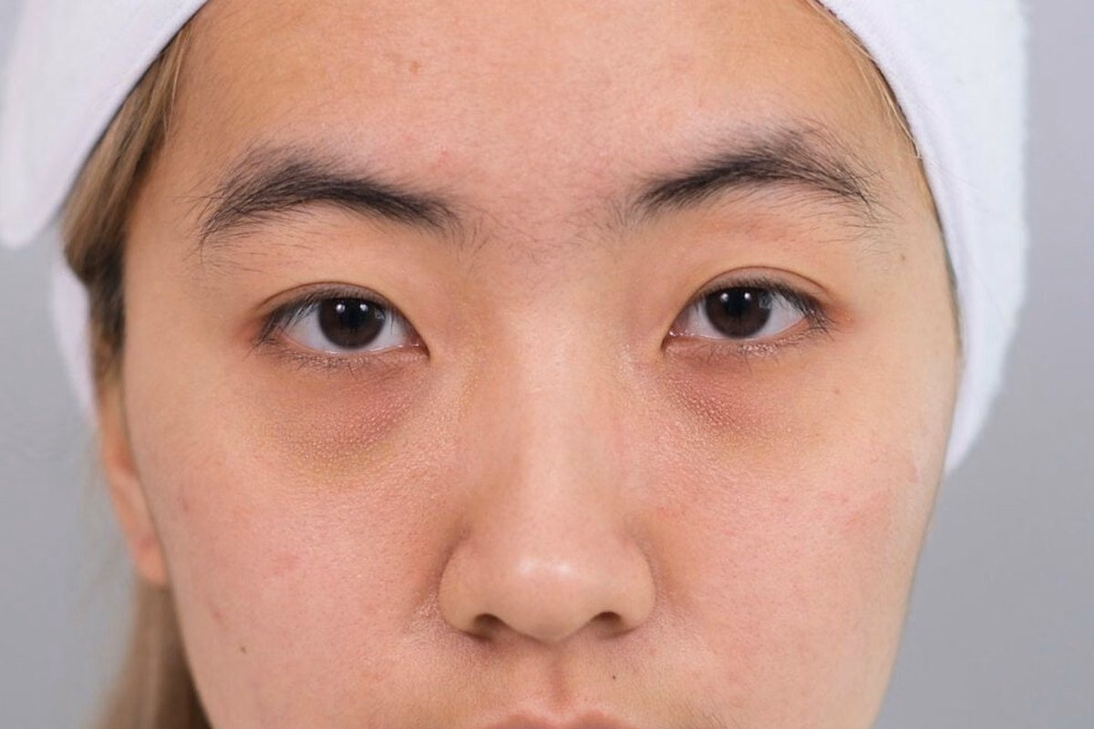 Lower Eyelid And Tear-Trough Region In A DCH Assessment Photograph