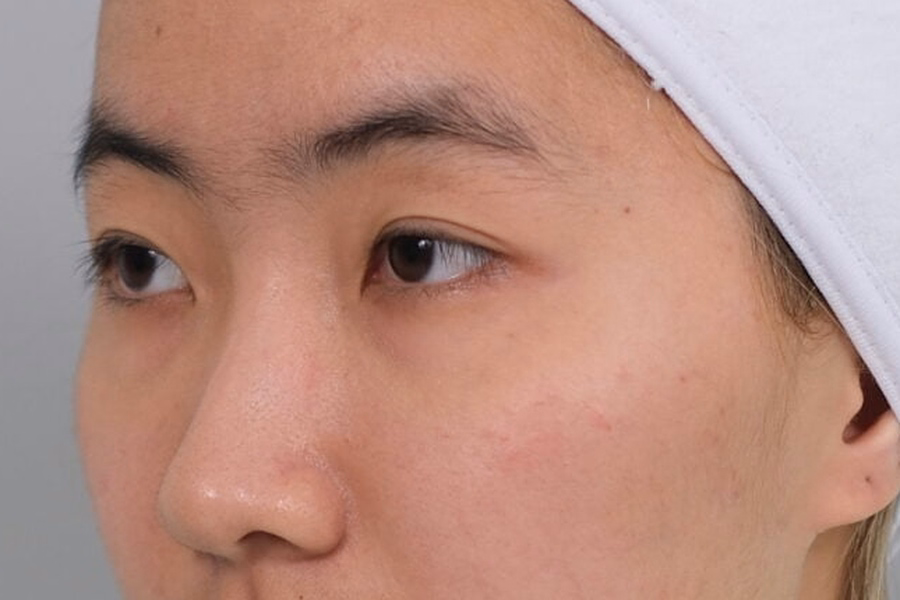 Skin Around The Lower Eyelid In A DCH Assessment Photograph