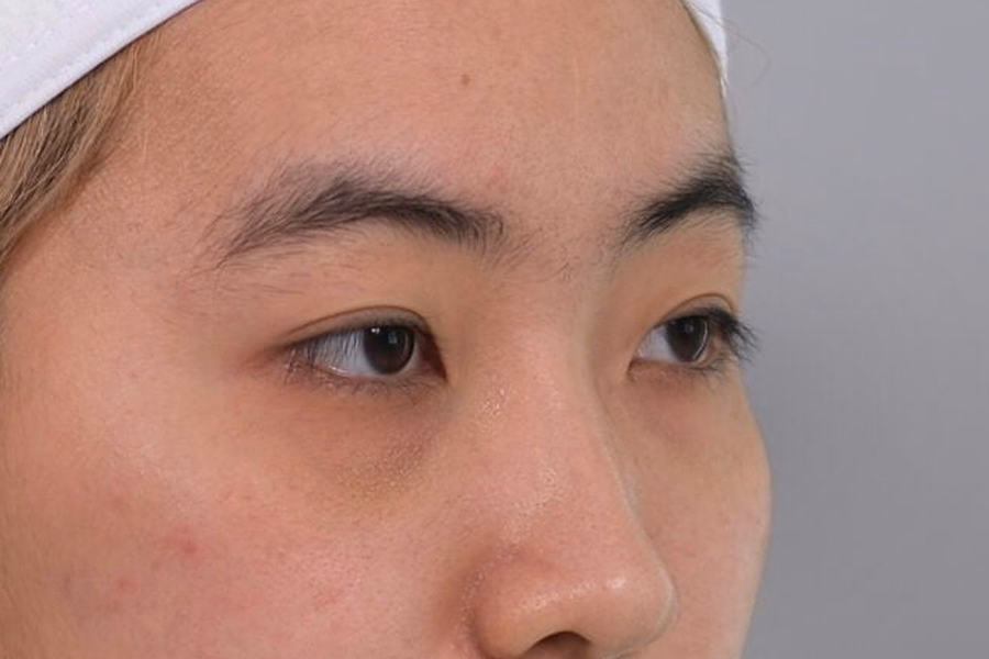 Oblique View Of The Lower Eyelid And Cheek In A DCH Photograph