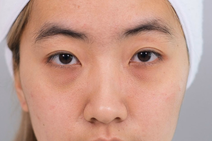 Lower Eyelid And Upper Cheek In A DCH Assessment Photograph