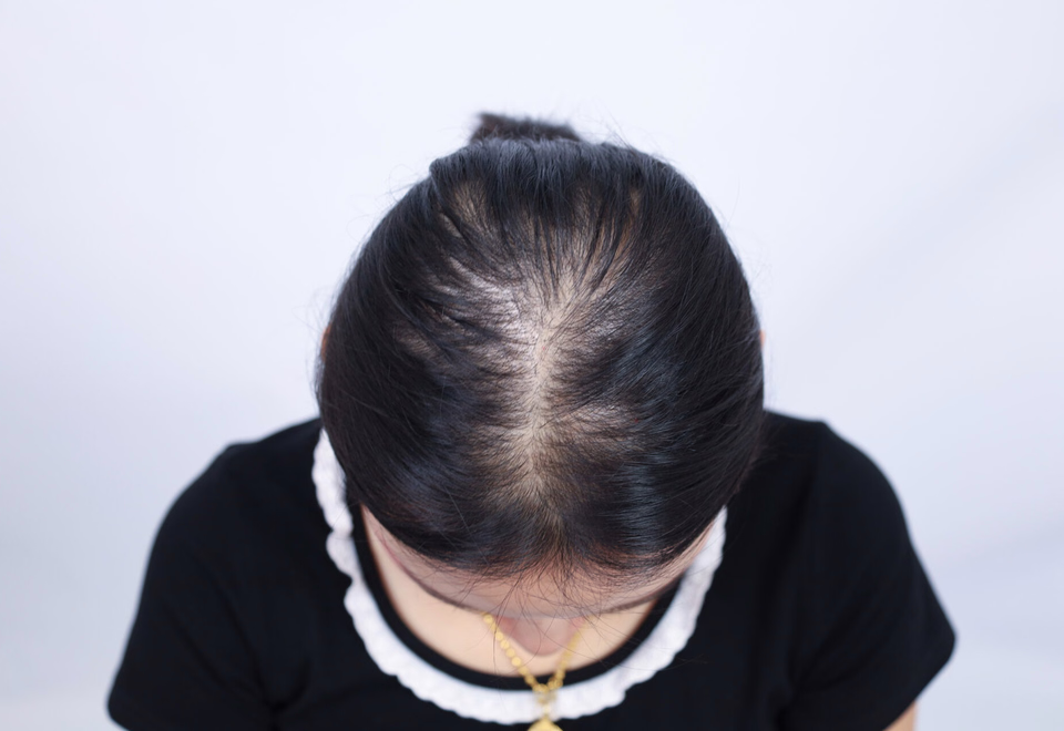 View Of Hair Thinning Around The Crown