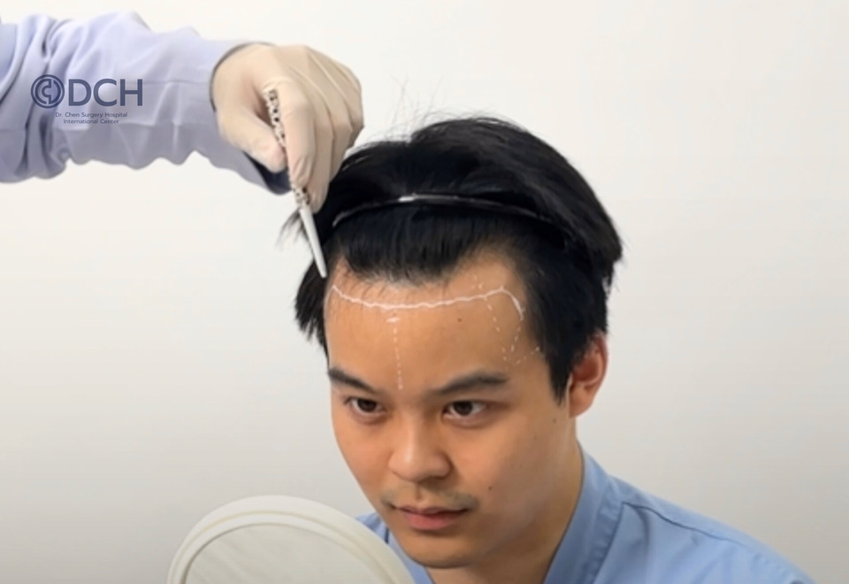 Hairline Design During A Hair Transplant Consultation