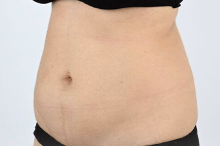 Abdominal Contours In A DCH Liposuction Assessment Photograph