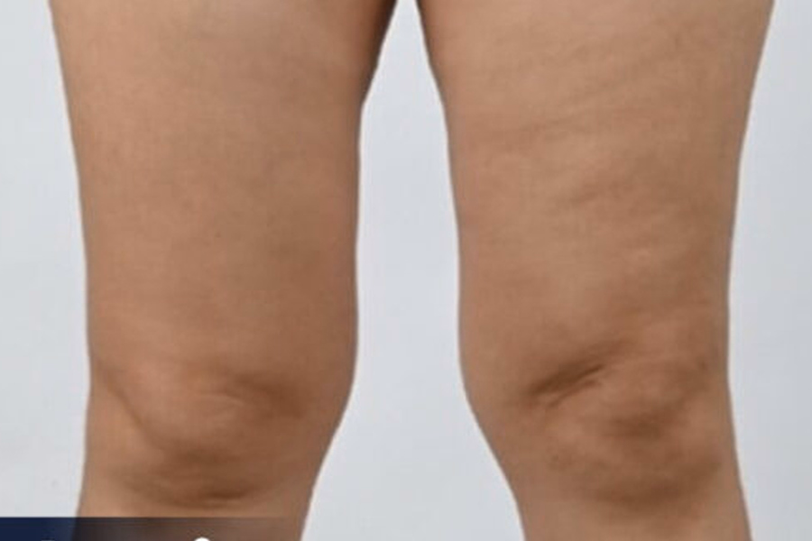 Thigh Contours In A DCH Liposuction Assessment Photograph