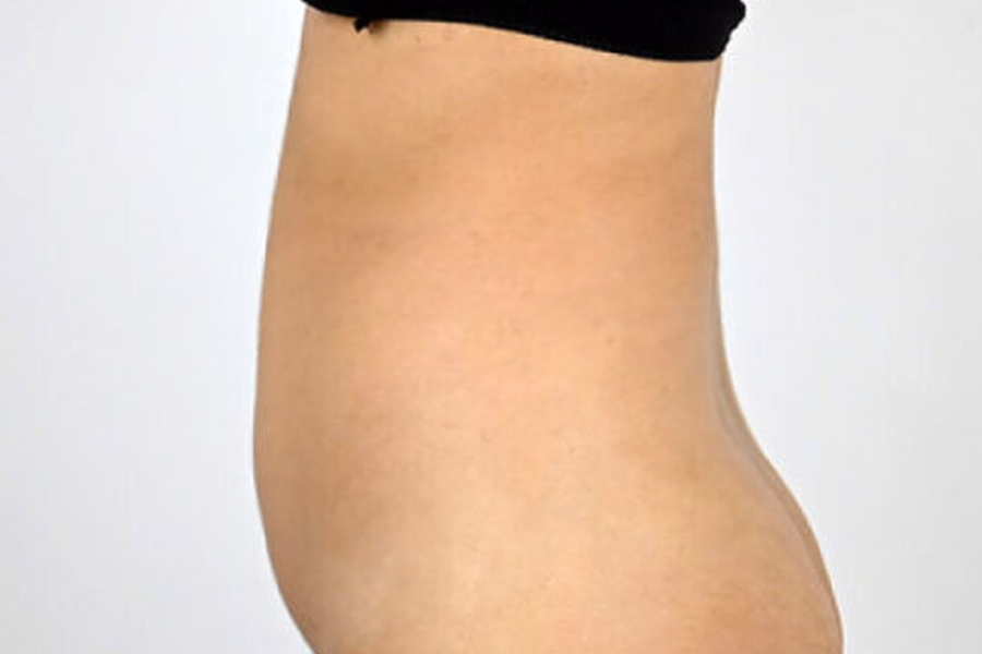 Side View Of The Waist In A DCH Liposuction Photograph